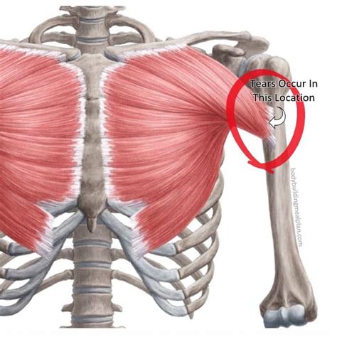 testing for pectoral major muscle tear|tear in pectoralis muscle.